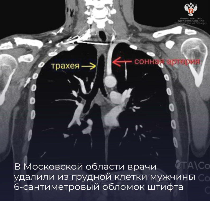 В Московской области врачи удалили из грудной клетки мужчины 6-сантиметровый обломок штифта