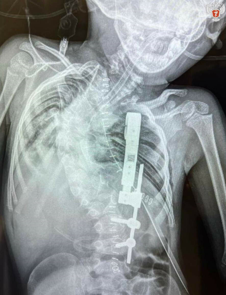 Девочке из Астрахани с тяжёлой формой врождённого сколиоза выполнена операция с применением уникальной отечественной рёберно-позвоночной металлоконструкции