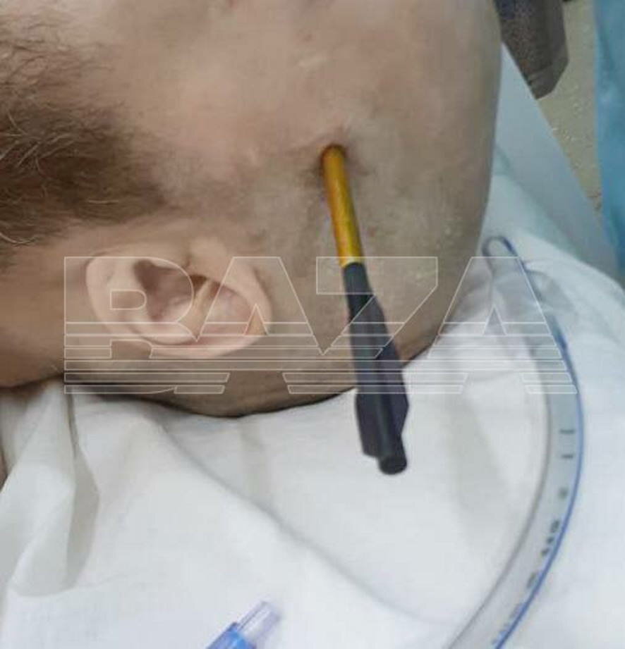 Нейрохирургам из Подмосковья удалось спасти мужчину, которому случайно выстрелили в голову из арбалета