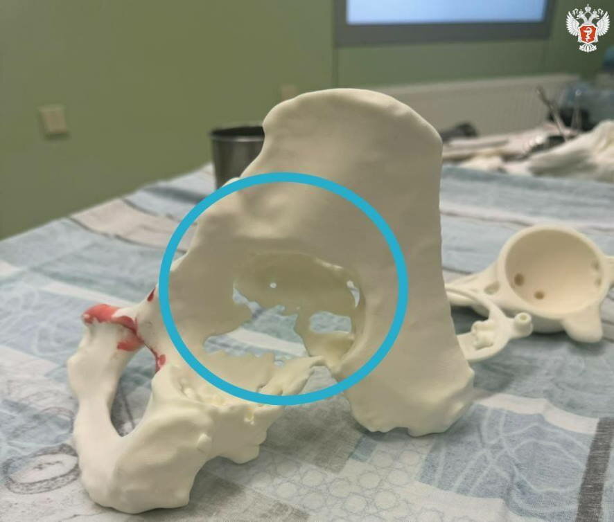 Сургутские врачи впервые установили индивидуальный 3D-эндопротез 70-летней пациентке с дефектом тазовой кости