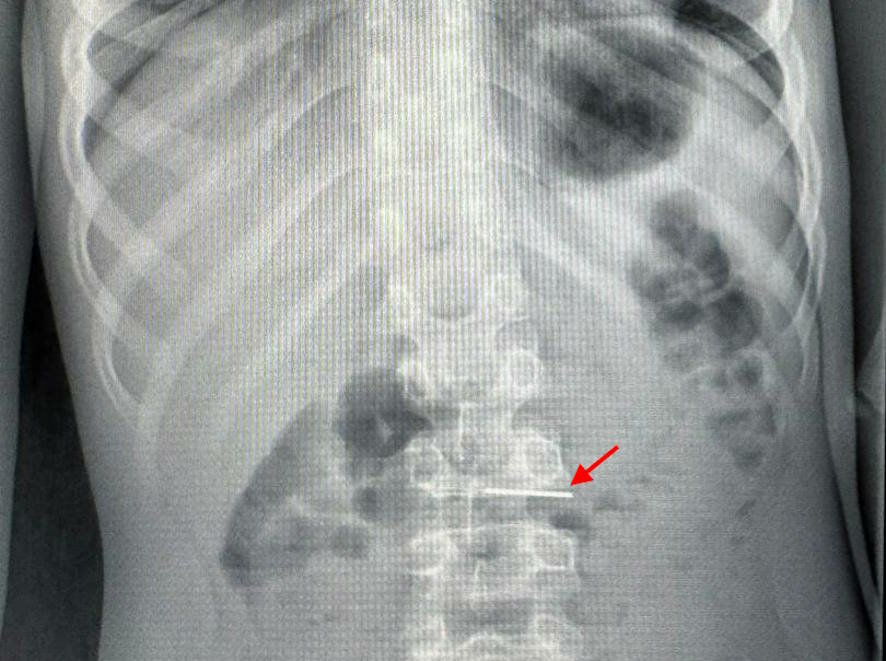 Врачи Центра Рошаля спасли мальчика, проглотившего иголку