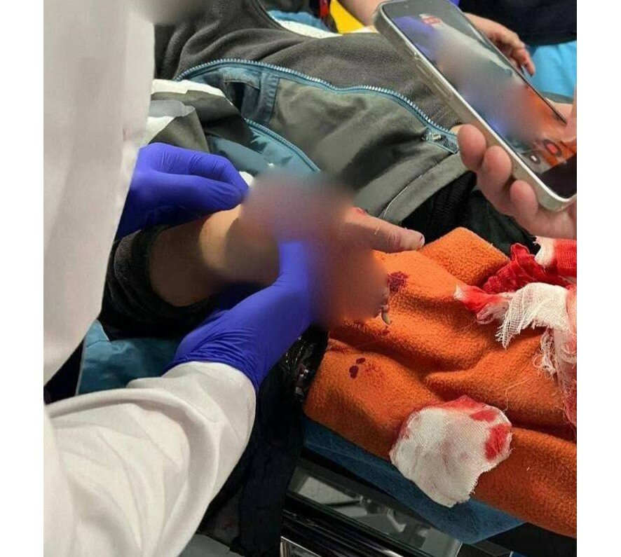 В Красногорске ребенок получил тяжелые ранения при взрыве взрывного устройства, замаскированного под пачку денег