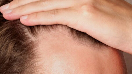 Учёные победили облысение: новый способ увеличивает рост волос на 539%. Но есть вопросы