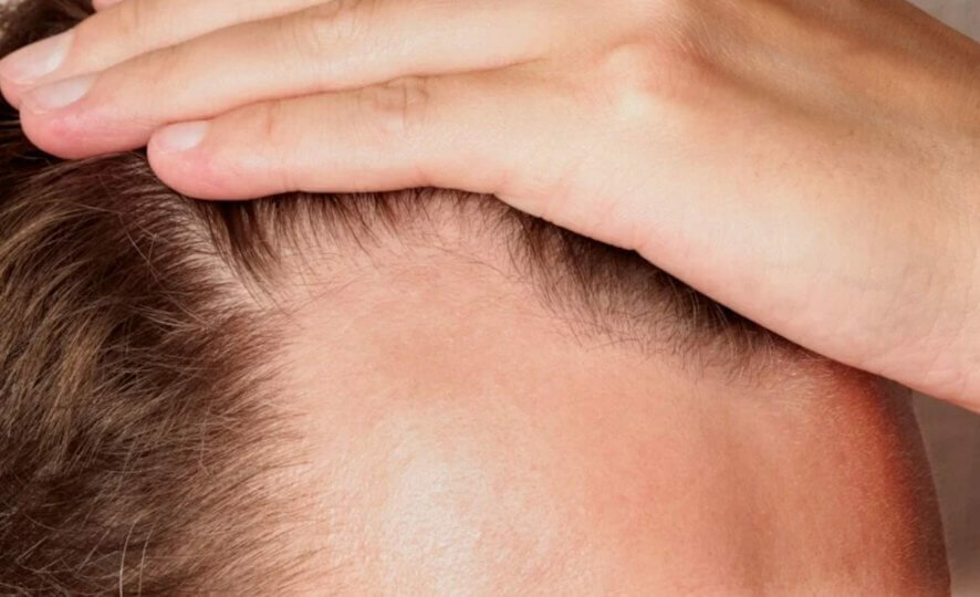 Учёные победили облысение: новый способ увеличивает рост волос на 539%. Но есть вопросы